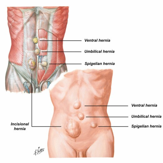 INCISIONAL-VENTRAL-HERNIA