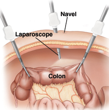 Diagnostic Laparascopy