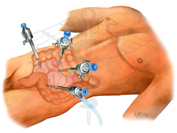 Diagnostic Laparascopy