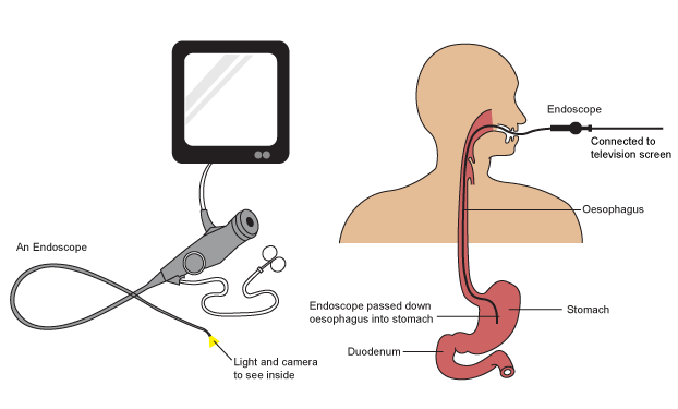 Laparascopic Appendectomy