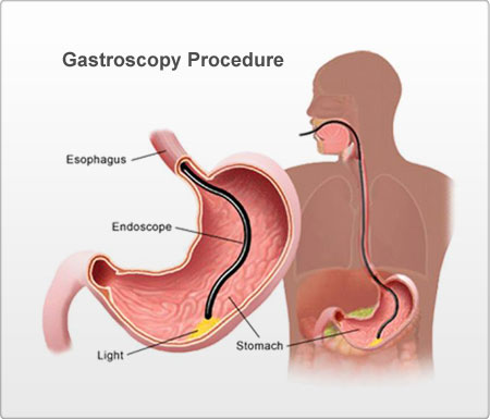 Laparascopic Appendectomy