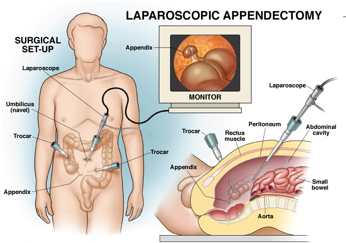 Laparascopic Appendectomy