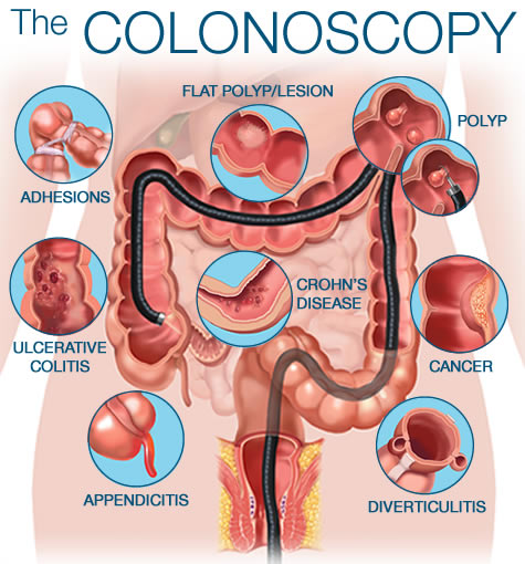 Laparascopic Appendectomy