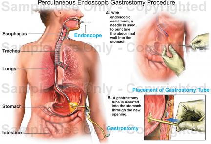 Laparascopic Appendectomy