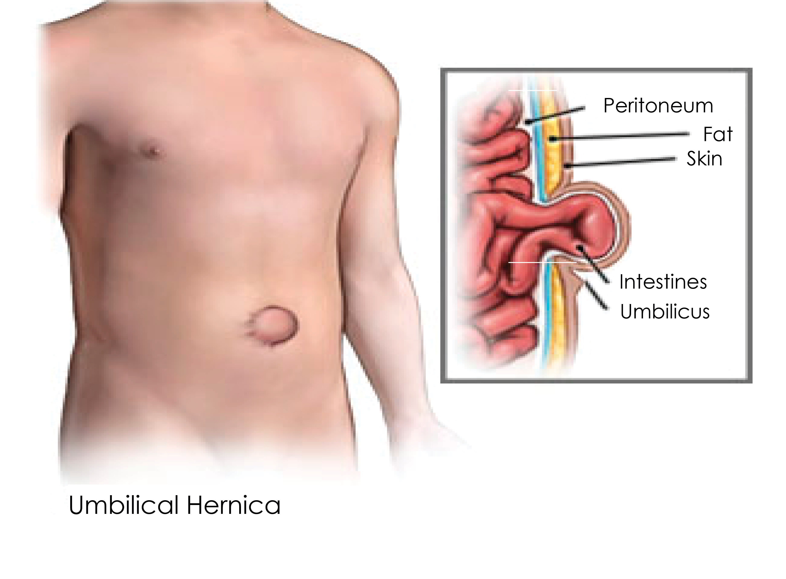 INCISIONAL-VENTRAL-HERNIA